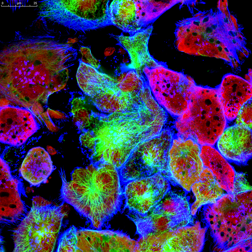 Tumor-cells-under-microscope-509859726_3200x3200-1