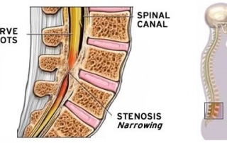 Illustration of Spinal Stenosis