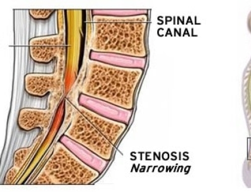 Spinal Stenosis Care in Wesley Chapel: Options for Lasting Relief
