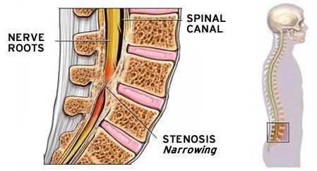 Illustration of Spinal Stenosis