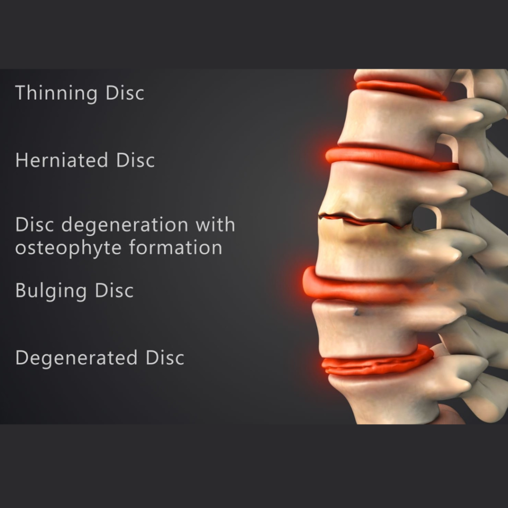 Illustration of a herniated and bulging disc