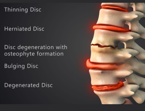 Herniated Disc vs. Bulging Disc: Understanding the Difference and Your Treatment Options